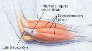 treatment for tendinopathy