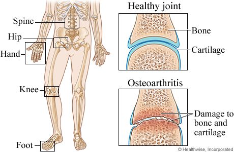 Osteoarthiritis