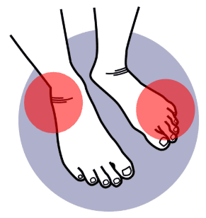 Stress Fractures & Undisplaced Fractures