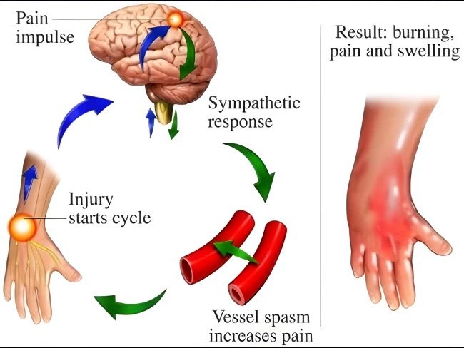 Complex-Regional-Pain-Syndrome-1