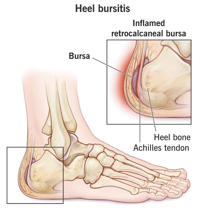 heel-bursitis
