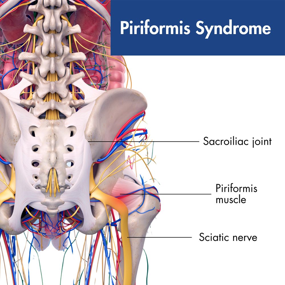 piriformis-syndrome