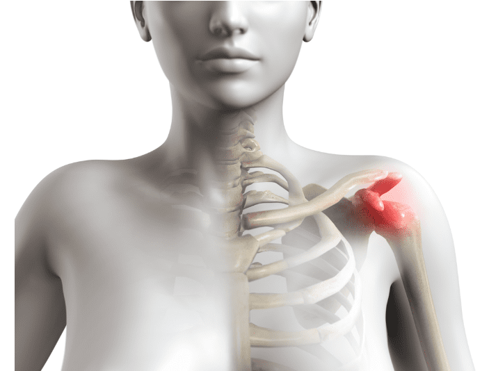 shoulder-impingement