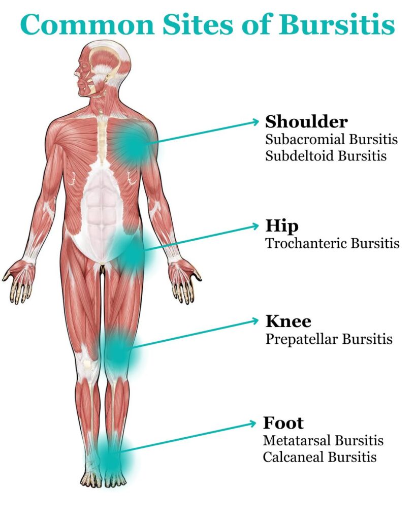 Bursitis