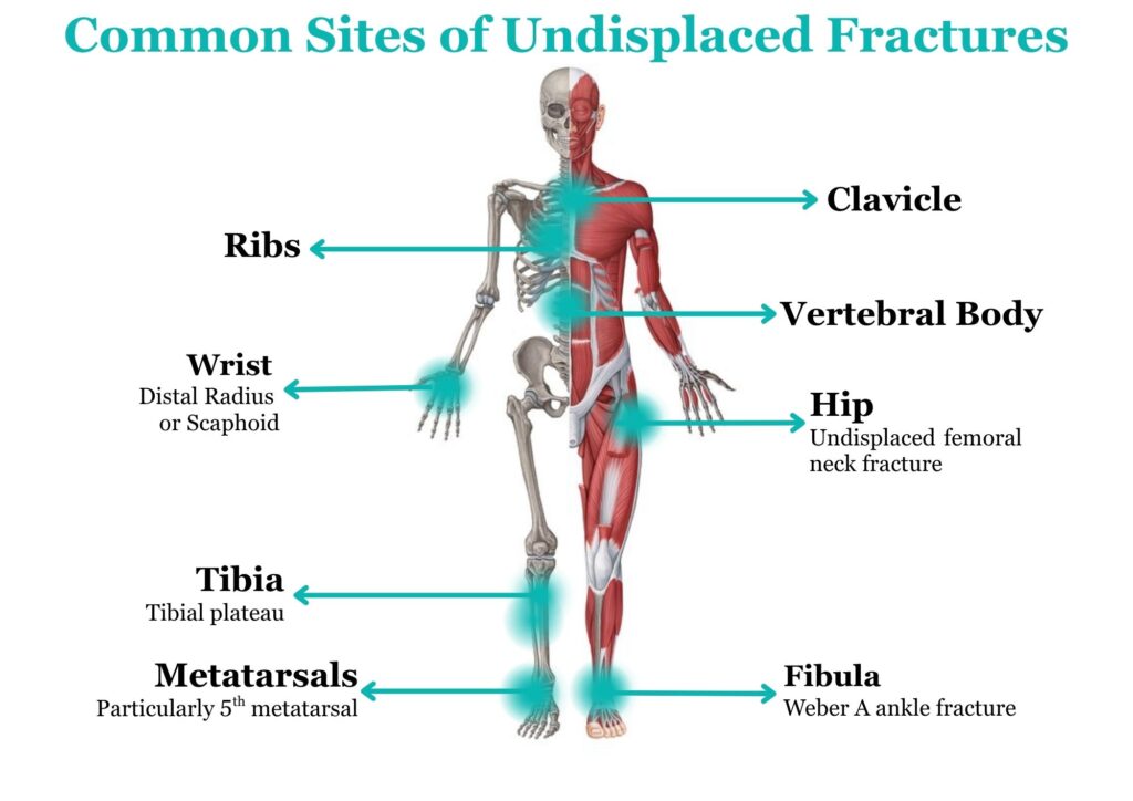 Undisplaced Fractures
