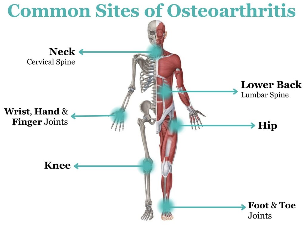 osteoarthritis